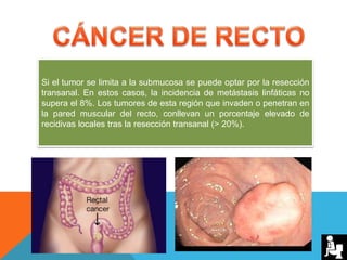 Si el tumor se limita a la submucosa se puede optar por la resección
transanal. En estos casos, la incidencia de metástasis linfáticas no
supera el 8%. Los tumores de esta región que invaden o penetran en
la pared muscular del recto, conllevan un porcentaje elevado de
recidivas locales tras la resección transanal (> 20%).
 
