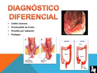  Colitis ulcerosa
 Proctocolitis de Crohn
 Proctitis por radiación
 Prolapso
 