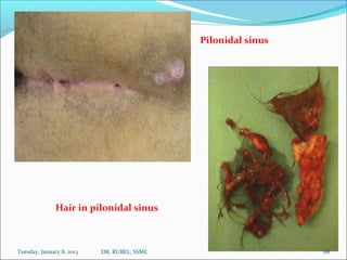 Pilonidal sinus




               Hair in pilonidal sinus



Tuesday, January 8, 2013   DR. RUBEL, SSMC                  ...