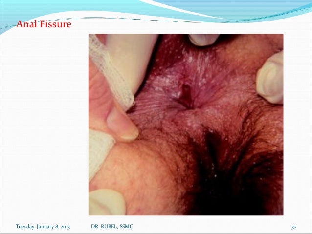 Rectum