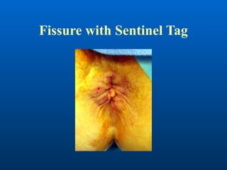 Comprehensive Overview of Common Anorectal Problems and Treatments | PPTX