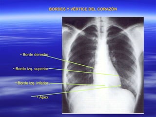 BORDES Y VÉRTICE DEL CORAZÓN Borde derecho Borde izq. superior Borde izq. inferior Apex 