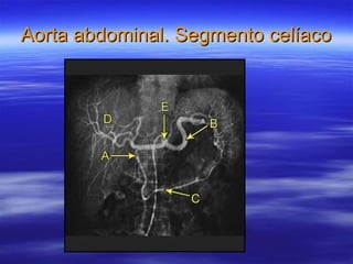 Aorta abdominal. Segmento celíaco 