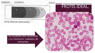 FROTIS IDEAL.
Se visualizan dos neutrófilos
y un monocito, rodeados de
eritrocitos.
 