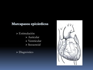 Marcapasos epicárdicos

     Estimulación
            Auricular
            Ventricular
            Secuencial


     Diagnóstico
 