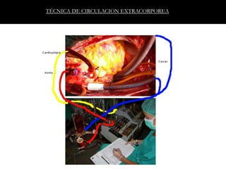 TÉCNICA DE CIRCULACION EXTRACORPOREA
 