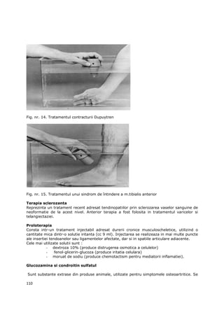 Fig. nr. 14. Tratamentul contracturii Dupuytren




Fig. nr. 15. Tratamentul unui sindrom de întindere a m.tibialis anterior

Terapia sclerozanta
Reprezinta un tratament recent adresat tendinopatiilor prin sclerozarea vaselor sanguine de
neoformatie de la acest nivel. Anterior terapia a fost folosita in tratamentul varicelor si
telangiectaziei.

Proloterapia
Consta intr-un tratament injectabil adresat durerii cronice musculoscheletice, utilizind o
cantitate mica dintr-o solutie iritanta (cc 9 ml). Injectarea se realizeaza in mai multe puncte
ale insertiei tendoanelor sau ligamentelor afectate, dar si in spatiile articulare adiacente.
Cele mai utilizate solutii sunt :
            - dextroza 10% (produce distrugerea osmotica a celulelor)
            -    fenol-glicerin-glucoza (produce iritatia celulara)
            - moruat de sodiu (produce chemotactism pentru mediatorii inflamatiei).

Glucozamina si condroitin sulfatul

Sunt substante extrase din produse animale, utilizate pentru simptomele osteoartritice. Se

110
 