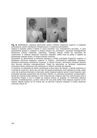 Fig. 8. Biofeedback: plasarea electrozilor pentru inhibitia trapezului superior si scaderea
activitatii(a), pentru facilitarea infraspinosului si cresterea activitatii(b).
Taping-ul scapular poate fi folosit in cazul prezentei unui impingement secundar, in care
pozitionarea gresita a scapulei in timpul miscarii de „overhead”, cauzeaza impingementul
tendonului coifului rotatorilor rotatorilor. Tapingul trebuie insotit de exercitiile de
reantrenare in vederea reeducarii muschilor scapulari, astfel incat sa poata fi capabili sa
pozitioneze scapula corect, in timpul miscarii umarului.
Cercetarile au demonstrat ca folosirea tapingul-ui inhiba activitatea trapezului superior si
faciliteaza activarea trapezului superior si mijlociu, imbunatatind stabilitatea scapulara,
facilitand mentinerea echilibrului muscular in timpul miscarii, permitand miscarea bratului
fara durerea aferenta impingementului. Poate de asemenea sa faciliteze reeducarea
musculara pentru obtinerea unei pozitionari si alinieri normale ale scapulei.
In practica, se foloseste de obicei combinarea a doua tipuri de taping: o banda protectiva si
o banda de sustinere. Doua sau trei fasii de banda protectoare sunt aplicate pe piele, peste
umar de la partea anterioara a claviculei, peste trapezul superior pana in josul scapulei, spre
procesele spinoase posterioare ale toracelui inferior. Cu pacientul pozitionat corespunzator,
banda de sustinere este aplicata in mai multe fasii din mijlocul celei mai voluminoase zone a
muschiului trapez in jos si medial de unghiul inferior al scapulei. In momentul aplicarii
benzilor, kinetoterapeutul, sustine umarul de sub axila astfel incat trapezul superior sa fie
relaxat. Banda trebuie sa fie intinsa dar sa permita miscarile scapulei in timpul abductiei
umarului (figura 9).




165
 