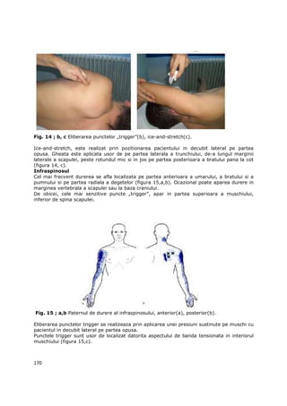Fig. 14 ; b, c Eliberarea punctelor „trigger”(b), ice-and-stretch(c).

Ice-and-stretch, este realizat prin pozitionarea pacientului in decubit lateral pe partea
opusa. Gheata este aplicata usor de pe partea laterala a trunchiului, de-a lungul marginii
laterale a scapulei, peste rotundul mic si in jos pe partea posterioara a bratului pana la cot
(figura 14, c).
Infraspinosul
Cel mai frecvent durerea se afla localizata pe partea anterioara a umarului, a bratului si a
pumnului si pe partea radiala a degetelor (figura 15,a,b). Ocazional poate aparea durere in
marginea vertebrala a scapulei sau la baza craniului.
De obicei, cele mai senzitive puncte „trigger”, apar in partea superioara a muschiului,
inferior de spina scapulei.




Fig. 15 ; a,b Paternul de durere al infraspinosului, anterior(a), posterior(b).

Eliberarea punctelor trigger se realizeaza prin aplicarea unei presiuni sustinute pe muschi cu
pacientul in decubit lateral pe partea opusa.
Punctele trigger sunt usor de localizat datorita aspectului de banda tensionata in interiorul
muschiului (figura 15,c).



170
 