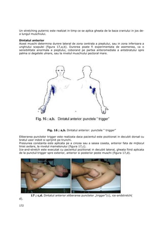 Un stretching puternic este realizat in timp ce se aplica gheata de la baza craniului in jos de-
a lungul muschiului.

Dintatul anterior
Acest muschi determina durere lateral de zona centrala a pieptului, sau in zona inferioara a
unghiului scapulei (figura 17,a,b). Durerea poate fi experimentata de asemenea, ca o
sensibilitate anormala a pieptului, coborand pe partea anteromediala a antebratului spre
palma si degetele ulnare, sau la nivelul muschiului pectoral mare.




                     Fig. 16 ; a,b. Dintatul anterior: punctele “ trigger”

Eliberarea punctelor trigger este realizata daca pacientul este pozitionat in decubit dorsal cu
bratul usor indoit si sprijinit pe trunchi.
Presiunea constanta este aplicata pe a cincea sau a sasea coasta, anterior fata de mijlocul
liniei axilare, la nivelul mamelonului (figura 17,c).
Ice-and-stretch este executat cu pacientul pozitionat in decubit lateral, gheata fiind aplicata
de la punctul trigger spre exterior, anterior si posterior peste muschi (figura 17,d).




        17 ; c,d. Dintatul anterior:eliberarea punctelor „trigger”(c), ice-andstretch(
d).

172
 
