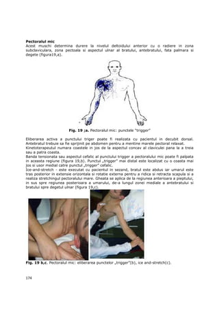 Pectoralul mic
Acest muschi determina durere la nivelul deltoidului anterior cu o radiere in zona
subclaviculara, zona pectoala si aspectul ulnar al bratului, antebratului, fata palmara si
degete (figura19,a).




                        Fig. 19 ;a. Pectoralul mic: punctele “trigger”

Eliberarea activa a punctului triger poate fi realizata cu pacientul in decubit dorsal.
Antebratul trebuie sa fie sprijinit pe abdomen pentru a mentine marele pectoral relaxat.
Kinetoterapeutul numara coastele in jos de la aspectul concav al claviculei pana la a treia
sau a patra coasta.
Banda tensionata sau aspectul cefalic al punctului trigger a pectoralului mic poate fi palpata
in aceasta regiune (figura 19,b). Punctul „trigger” mai distal este localizat cu o coasta mai
jos si usor medial catre punctul „trigger” cefalic.
Ice-and-stretch - este executat cu pacientul in sezand, bratul este abdus iar umarul este
tras posterior in extensie orizontala si rotatie externa pentru a ridica si retracta scapula si a
realiza stretchingul pectoralului mare. Gheata se aplica de la regiunea anterioara a pieptului,
in sus spre regiunea posterioara a umarului, de-a lungul zonei mediale a antebratului si
bratului spre degetul ulnar (figura 19,c).




Fig. 19 b,c. Pectoralul mic: eliberarea punctelor „trigger”(b), ice and-stretch(c).



174
 
