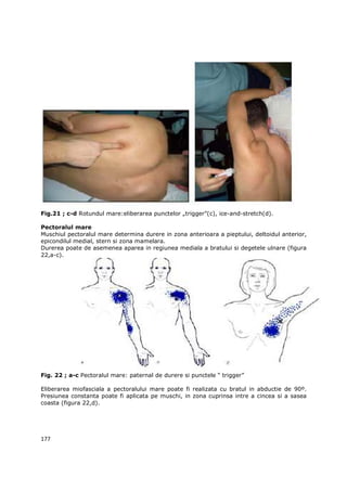 Fig.21 ; c-d Rotundul mare:eliberarea punctelor „trigger”(c), ice-and-stretch(d).

Pectoralul mare
Muschiul pectoralul mare determina durere in zona anterioara a pieptului, deltoidul anterior,
epicondilul medial, stern si zona mamelara.
Durerea poate de asemenea aparea in regiunea mediala a bratului si degetele ulnare (figura
22,a-c).




Fig. 22 ; a-c Pectoralul mare: paternal de durere si punctele “ trigger”

Eliberarea miofasciala a pectoralului mare poate fi realizata cu bratul in abductie de 90º.
Presiunea constanta poate fi aplicata pe muschi, in zona cuprinsa intre a cincea si a sasea
coasta (figura 22,d).




177
 