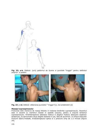 Fig. 23; a-b. Deltoid: (a-b) patternul de durere si punctele “trigger” pentru deltoidul
anterior. si posteri




Fig. 23 ; c-d. Deltoid: eliberarea punctelor “ trigger”(c), Ice-andstretch (d)

Masajul supraspinosului
Frictiunea este manevra de masaj folosita in tratarea tendinitei supraspinosului. Pacientul
este in sezand cu membrul rotatat in spatele corpului, pentru a expune tendonul
supraspinosului. Kinetoterapeutul plaseaza indexul si degetul mijlociu deasupra capatului
tendonului, la aproximativ doua degete distanta in jos, fata de acromion. In timpul executiei
frictiunii latero-mediale, kinetoterapeutul aplica si o presiune timp de 1-2 minute (figura
24).

179
 