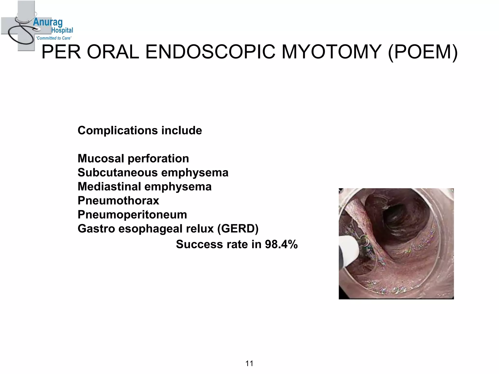 PER ORAL ENDOSCOPIC MYOTOMY (POEM)
Complications include
Mucosal perforation
Subcutaneous emphysema
Mediastinal emphysema
Pneumothorax
Pneumoperitoneum
Gastro esophageal relux (GERD)
Success rate in 98.4%
11
 