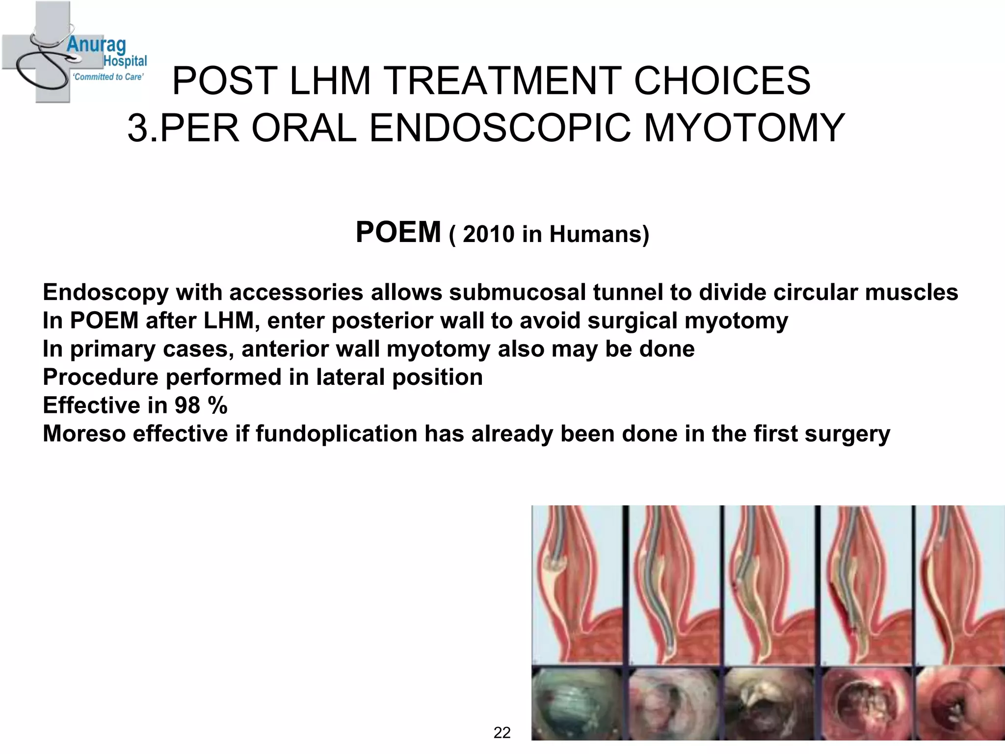 POST LHM TREATMENT CHOICES
3.PER ORAL ENDOSCOPIC MYOTOMY
POEM ( 2010 in Humans)
Endoscopy with accessories allows submucosal tunnel to divide circular muscles
In POEM after LHM, enter posterior wall to avoid surgical myotomy
In primary cases, anterior wall myotomy also may be done
Procedure performed in lateral position
Effective in 98 %
Moreso effective if fundoplication has already been done in the first surgery
22
 