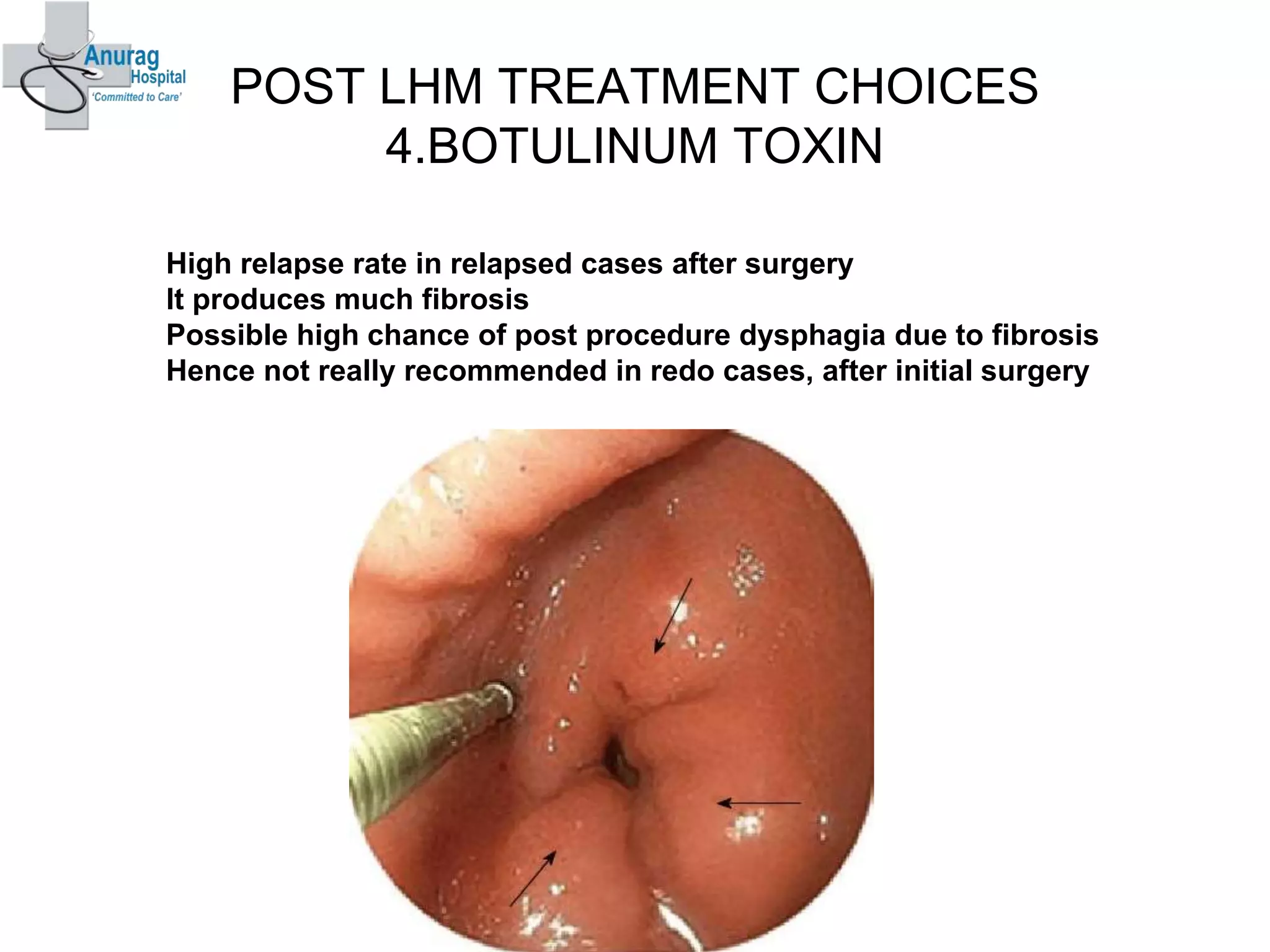 POST LHM TREATMENT CHOICES
4.BOTULINUM TOXIN
High relapse rate in relapsed cases after surgery
It produces much fibrosis
Possible high chance of post procedure dysphagia due to fibrosis
Hence not really recommended in redo cases, after initial surgery
23
 