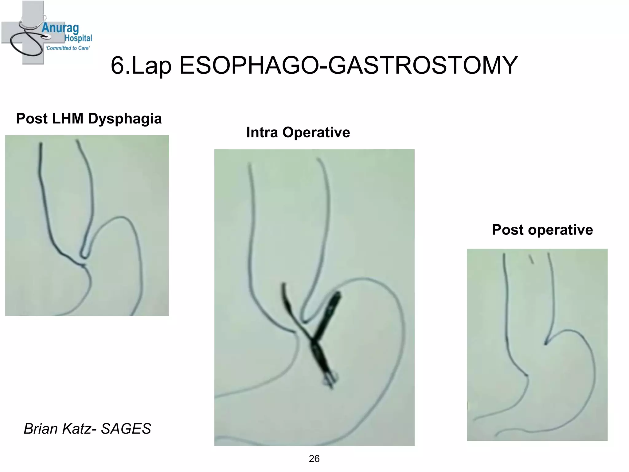 6.Lap ESOPHAGO-GASTROSTOMY
26
Post LHM Dysphagia
Intra Operative
Post operative
Brian Katz- SAGES
 
