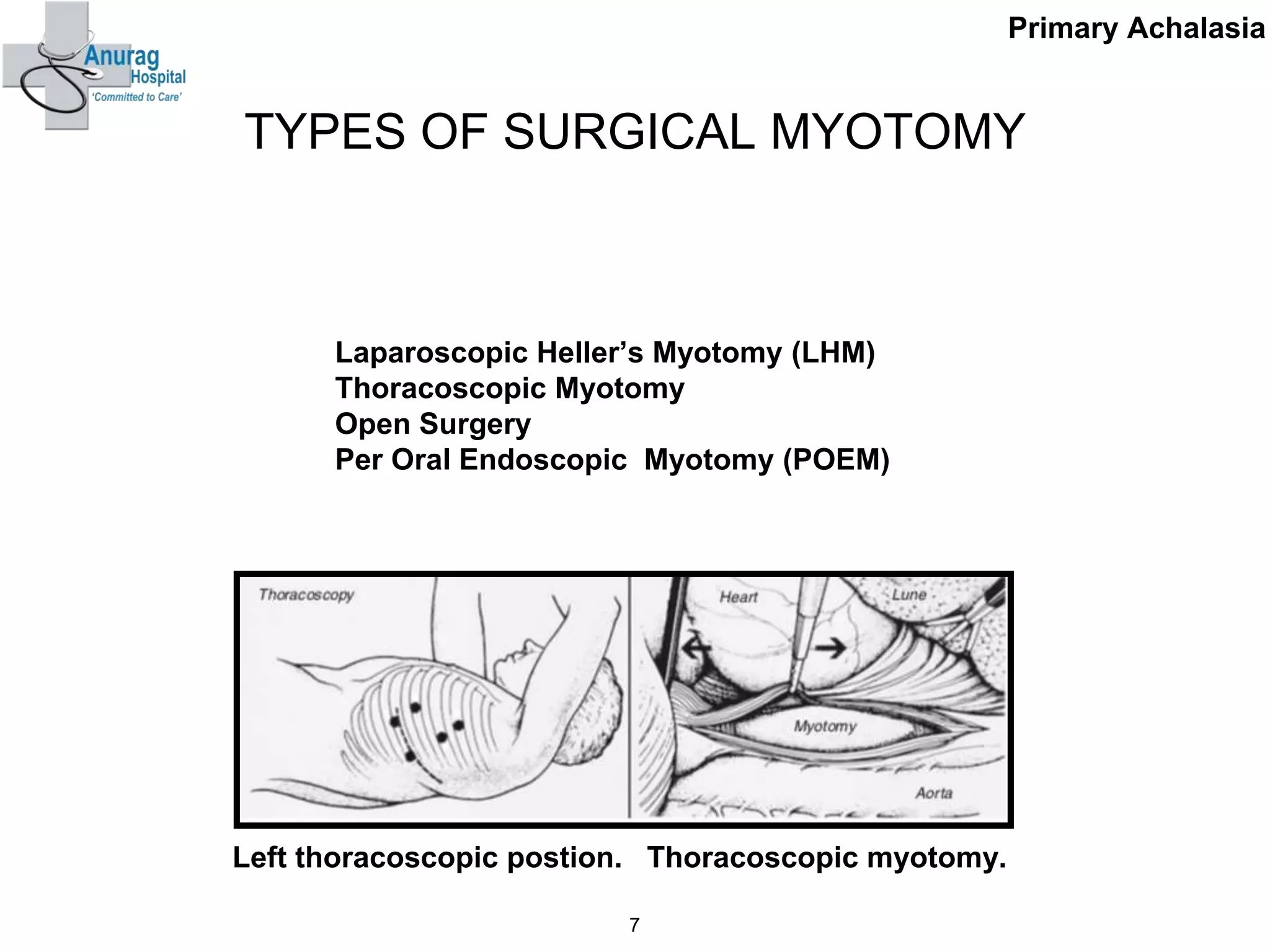 TYPES OF SURGICAL MYOTOMY
Laparoscopic Heller’s Myotomy (LHM)
Thoracoscopic Myotomy
Open Surgery
Per Oral Endoscopic Myotomy (POEM)
7
Primary Achalasia
Left thoracoscopic postion. Thoracoscopic myotomy.
 