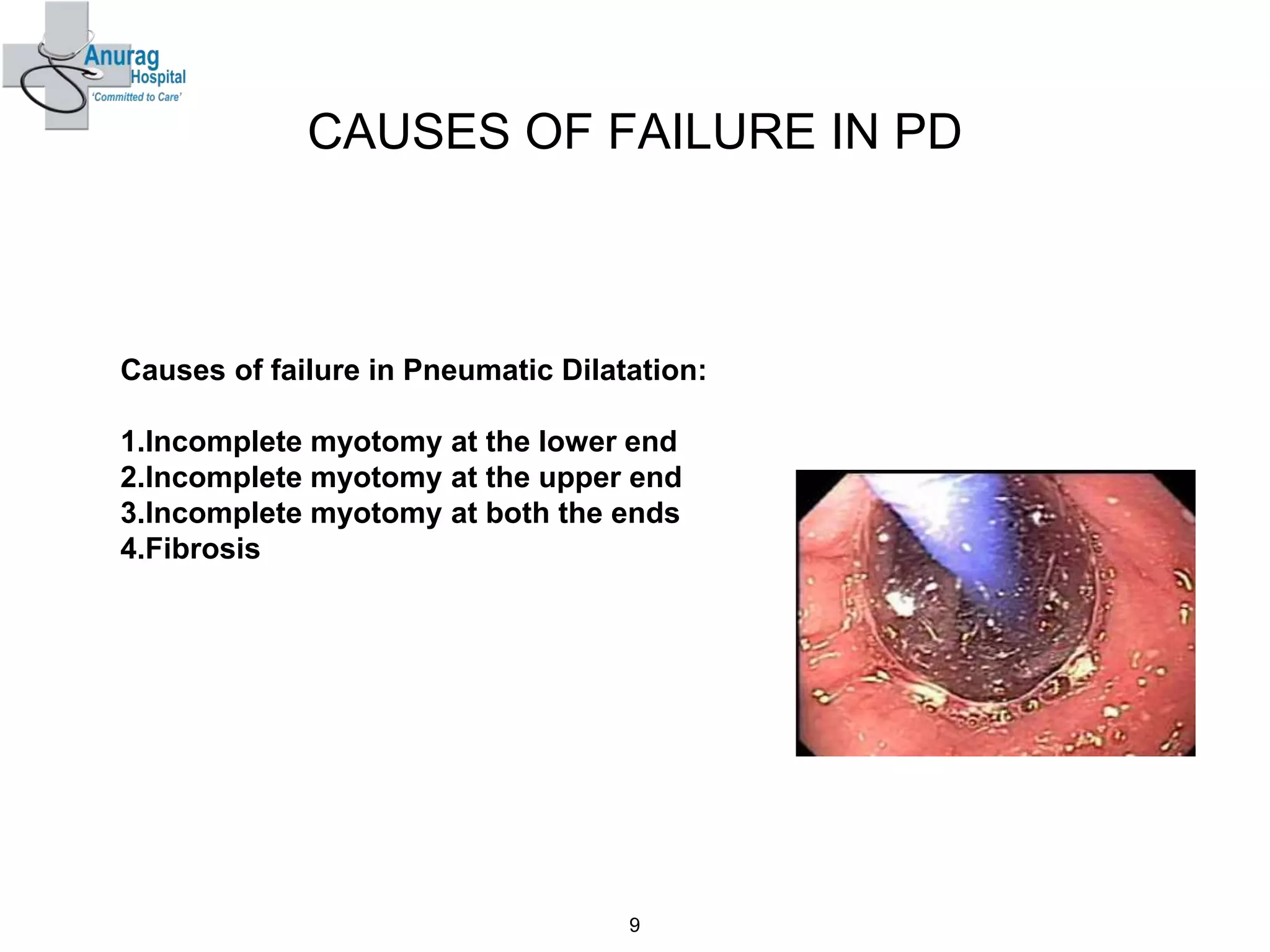 CAUSES OF FAILURE IN PD
Causes of failure in Pneumatic Dilatation:
1.Incomplete myotomy at the lower end
2.Incomplete myotomy at the upper end
3.Incomplete myotomy at both the ends
4.Fibrosis
9
 