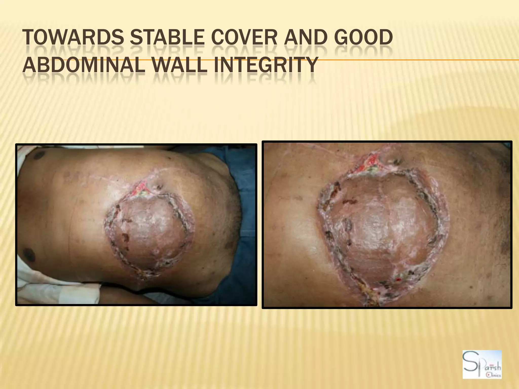 Towards stable cover and good abdominal wall integrity