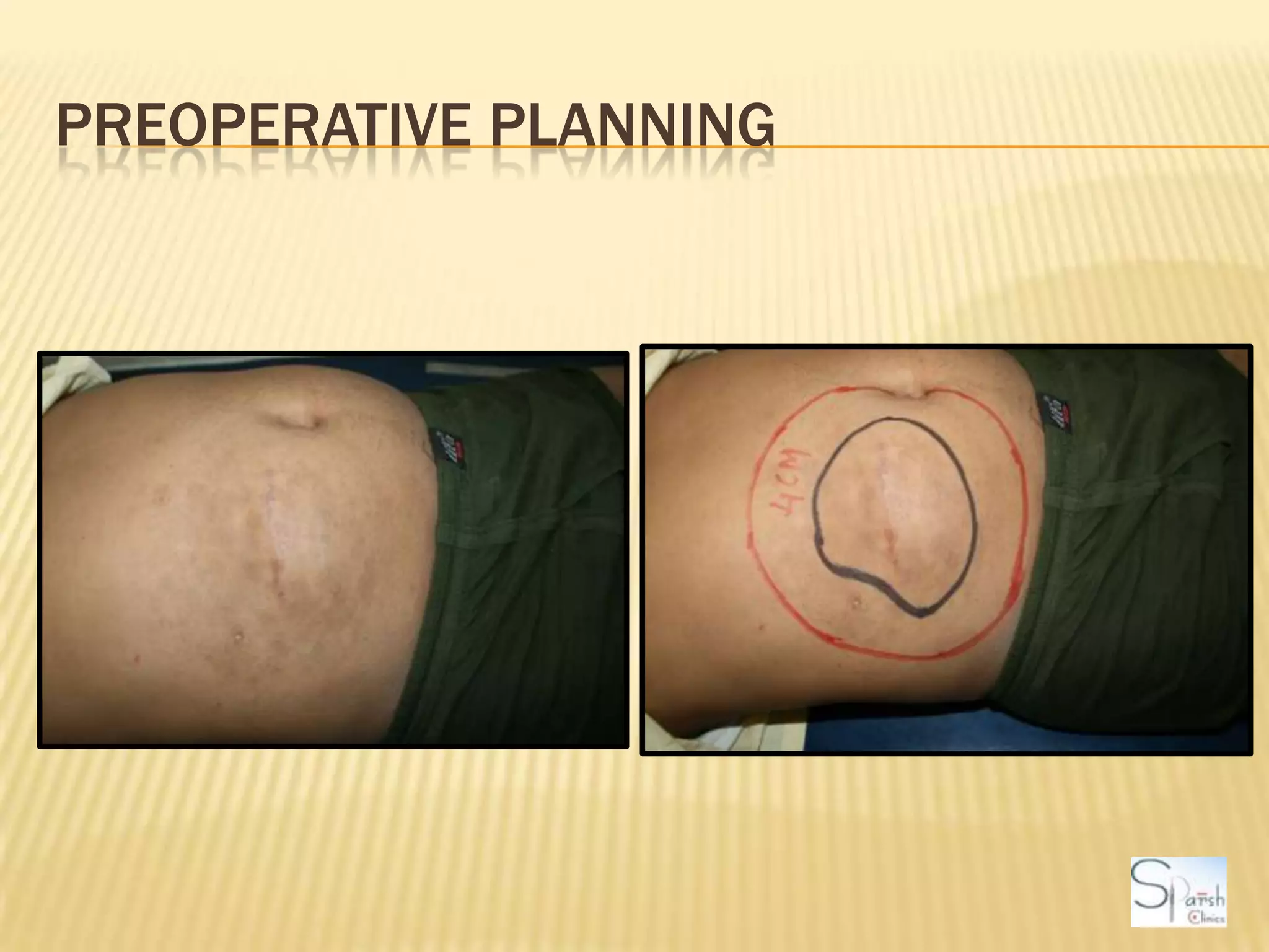 Preoperative Planning