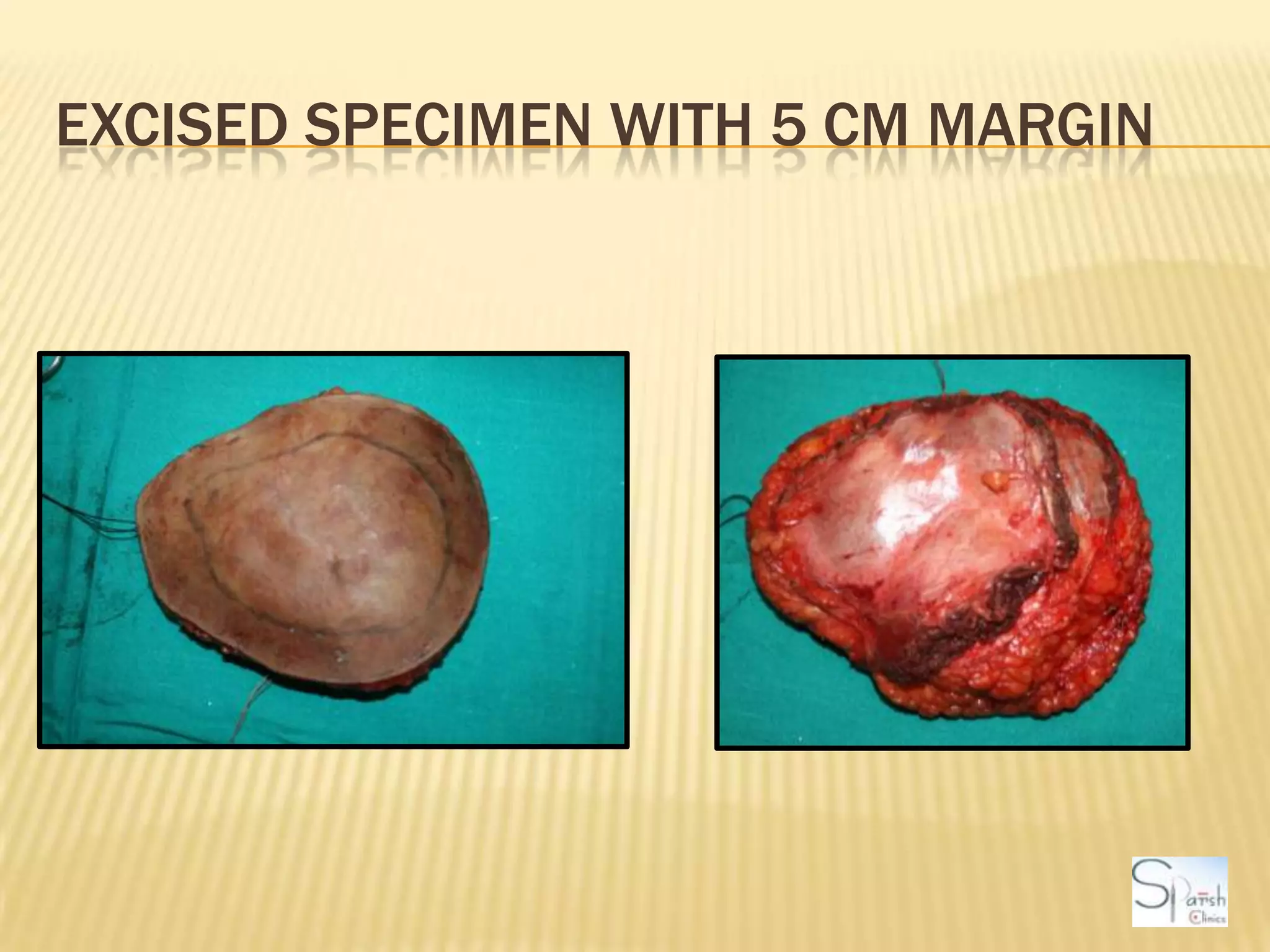 Excised Specimen with 5 cm margin