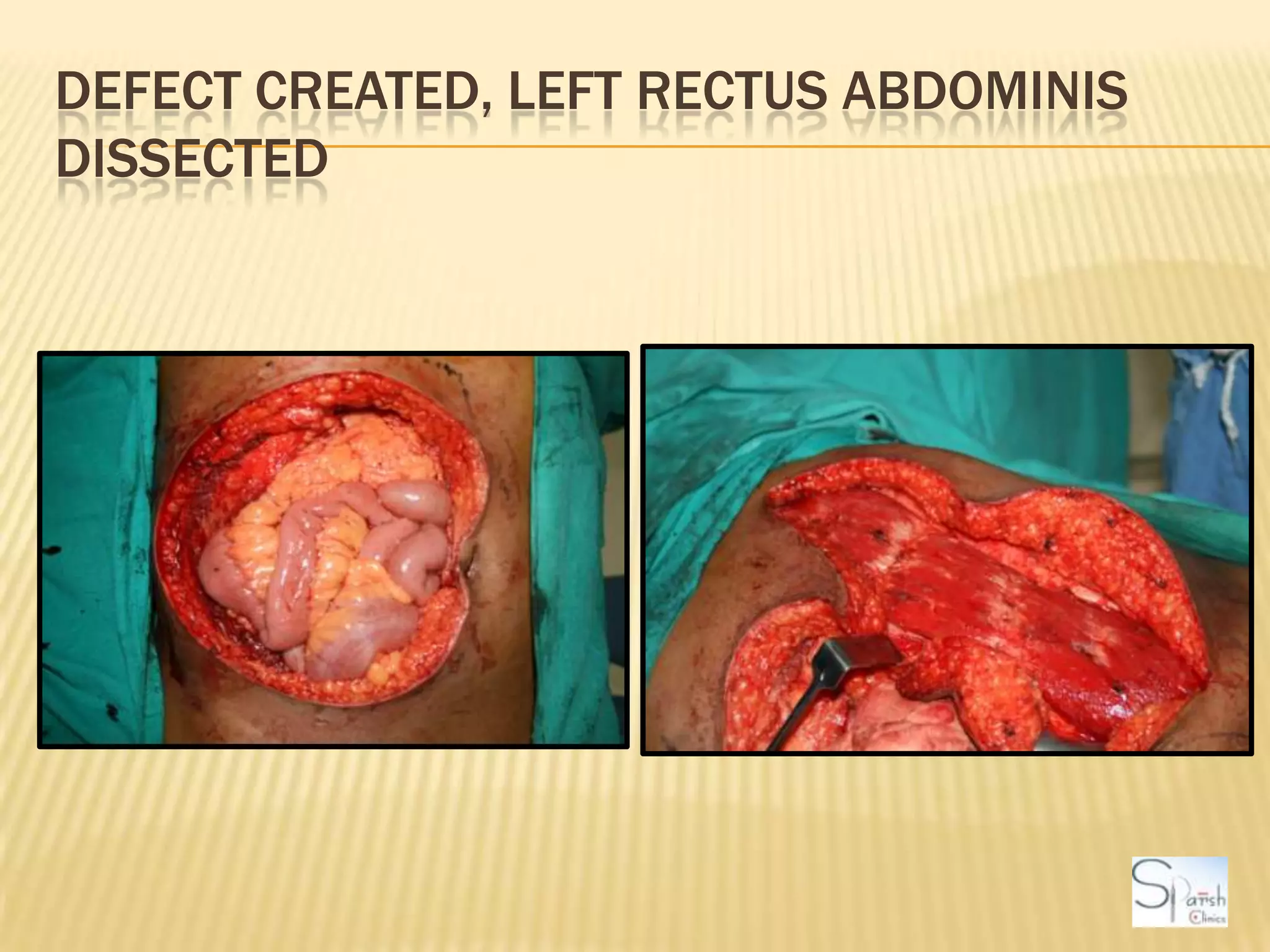 Defect created, Left rectus abdominis dissected