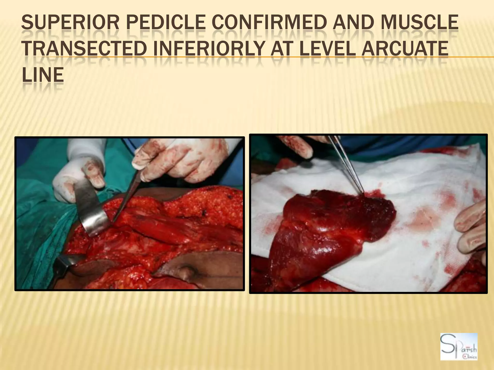Superior Pedicle confirmed and muscle transected inferiorly at level arcuate line