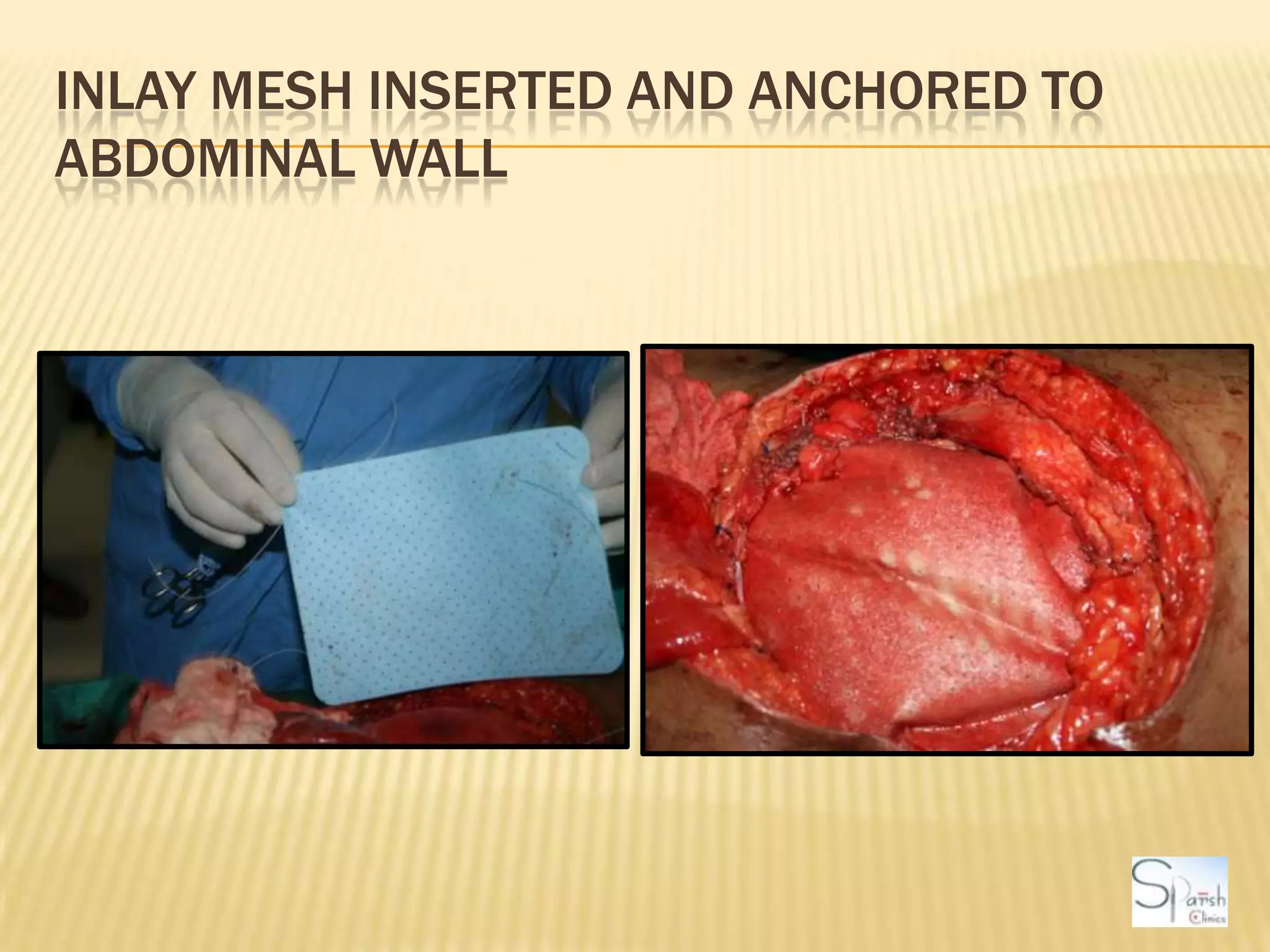 Inlay Mesh inserted and anchored to abdominal wall