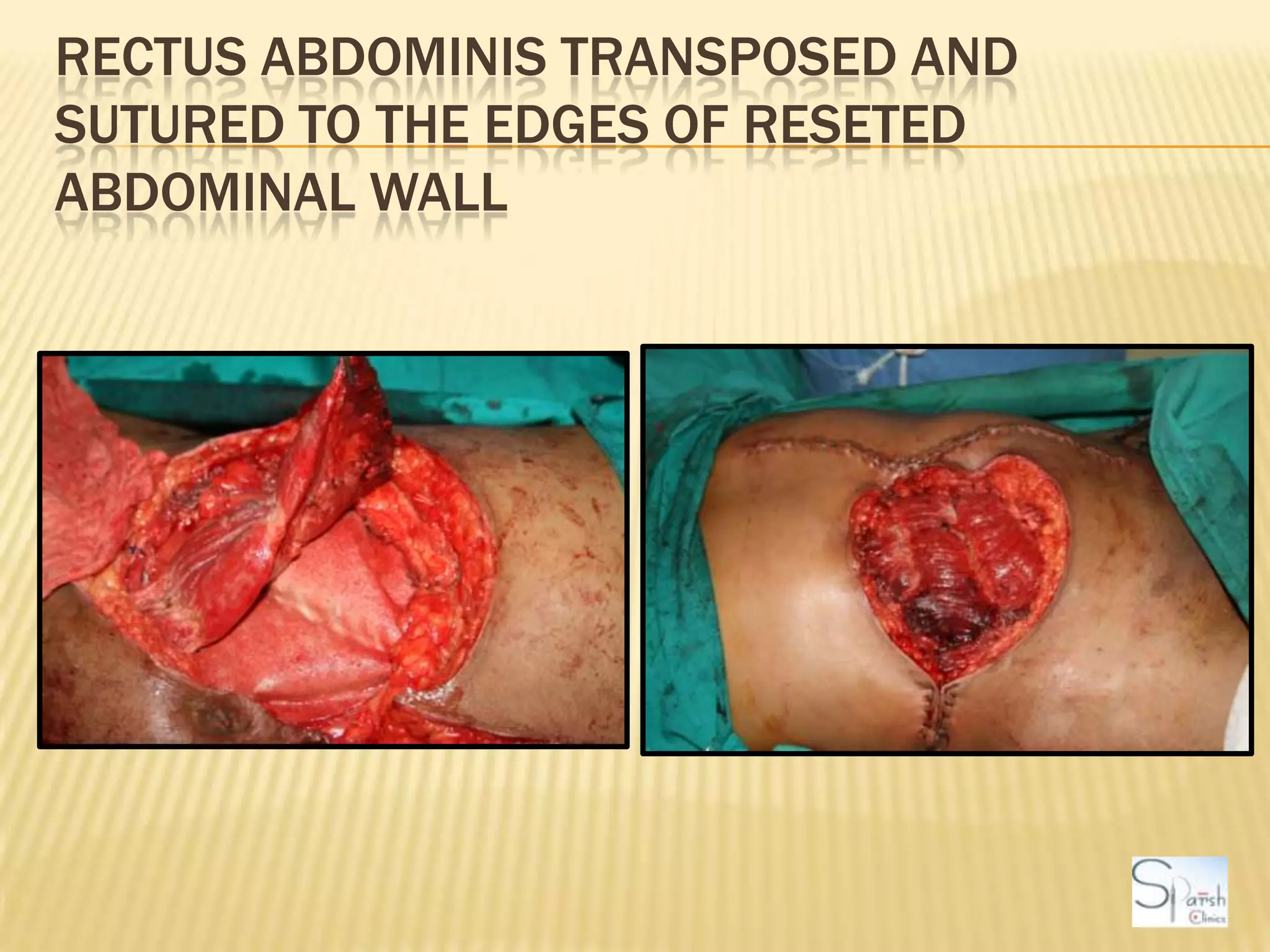 Rectus Abdominis transposed and sutured to the edges of reseted abdominal wall