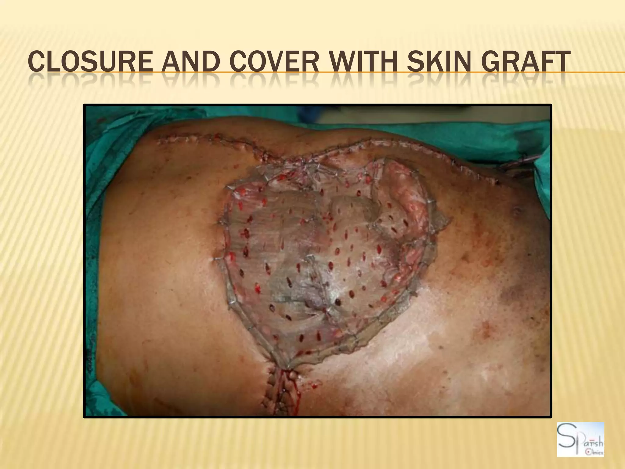 Closure and cover with skin graft