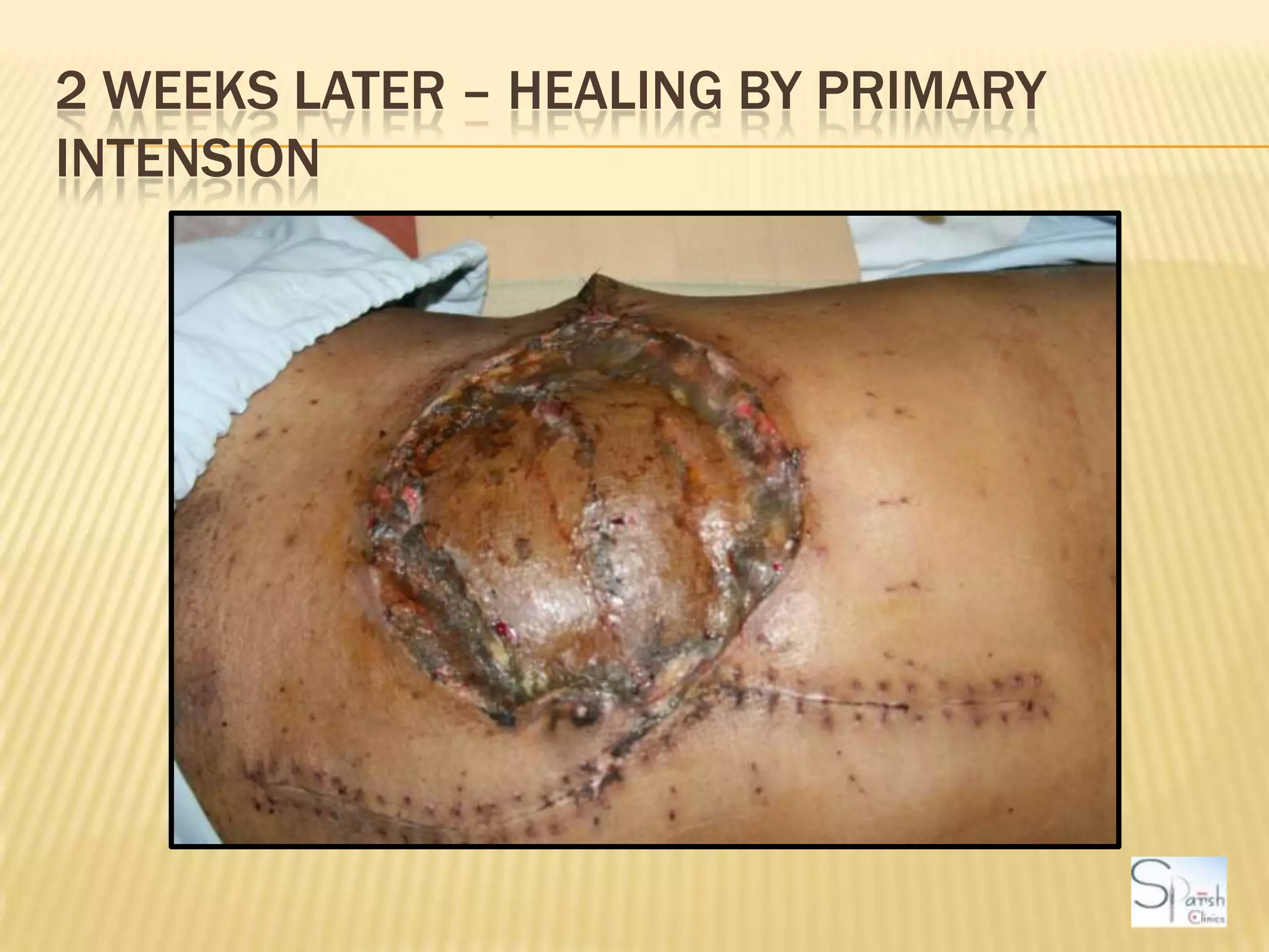 2 weeks later – Healing by primary intension