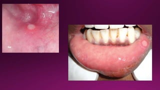 Major Ras Recurrent aphthous stomatitis | PPTX