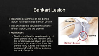 Recurrent Dislocation of Shoulder.pptx