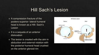 Recurrent Dislocation of Shoulder.pptx