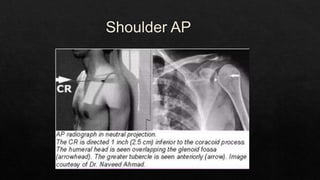 Recurrent Dislocation of Shoulder.pptx