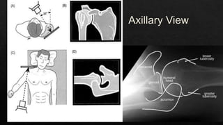 Recurrent Dislocation of Shoulder.pptx
