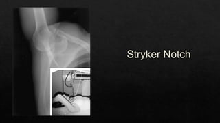 Recurrent Dislocation of Shoulder.pptx