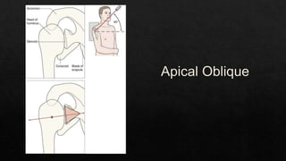 Recurrent Dislocation of Shoulder.pptx