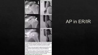 Recurrent Dislocation of Shoulder.pptx