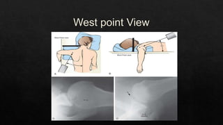 Recurrent Dislocation of Shoulder.pptx