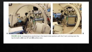 Recurrent Dislocation of Shoulder.pptx