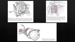 Recurrent Dislocation of Shoulder.pptx
