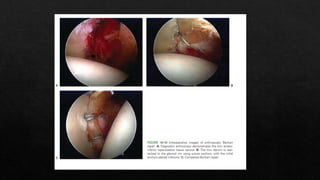 Recurrent Dislocation of Shoulder.pptx