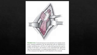 Recurrent Dislocation of Shoulder.pptx