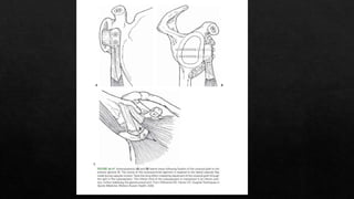 Recurrent Dislocation of Shoulder.pptx