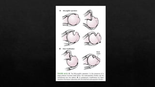 Recurrent Dislocation of Shoulder.pptx