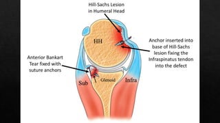 Recurrent Dislocation of Shoulder.pptx