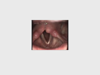 Recurrent laryngeal nerve paralysis