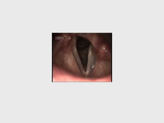 Recurrent laryngeal nerve paralysis